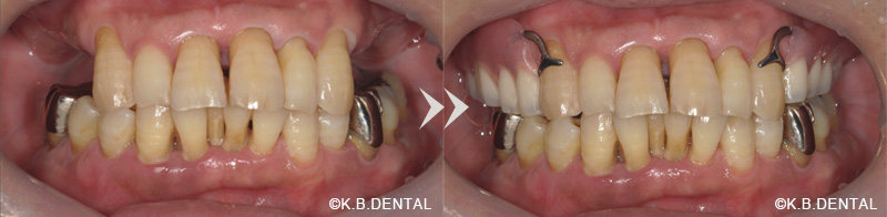 部分金属床（チタン）無口蓋義歯＋特殊維持装置