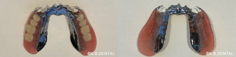 部分金属床（チタン）無口蓋義歯＋特殊維持装置