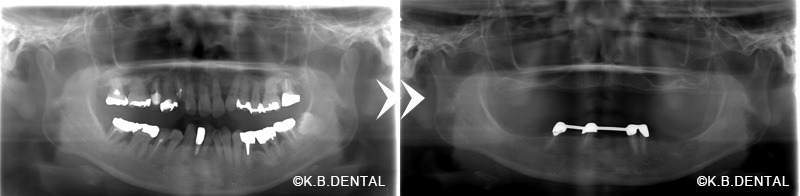 金属床総義歯（チタン）＋残存歯をドルダーバー
