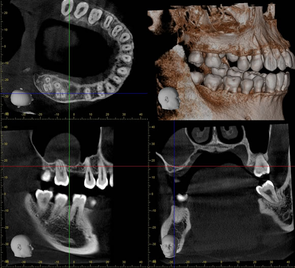 上顎洞CT画像