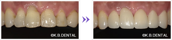 後退した歯ぐきの歯周病治療