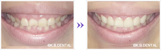歯科 ガミー スマイル 審美 笑うと歯茎が目立つガミースマイルの原因・治療法とは？