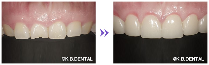 前歯：歯冠延長術法によるガミースマイル