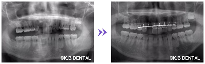 歯槽骨骨折・歯牙亜脱臼