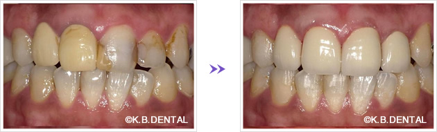 オールセラミッククラウン前歯の症例