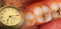 短期間 虫歯治療