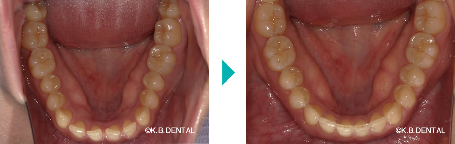 下顎：すきっ歯治療例