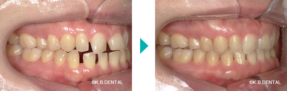 右側：すきっ歯治療例