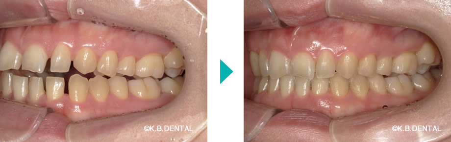 左側：すきっ歯治療例