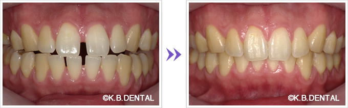 前歯：すきっ歯改善