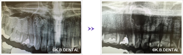 歯牙腫摘出